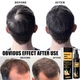 Advanced Hair Growth Treatment Kit 30ml 2 STK Hair Growth Spray Hårvækst Roller og Essence Set Hair Growth Serum Anti Hårtab Advanced Hair Growth Serum Hair Care Naty Shop