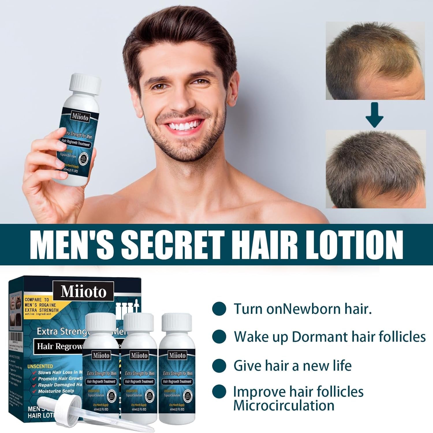 Miioto Hårvækst Serum Mænd Hårvækst Produkt Hårvækst Hår Serum Hovedbundspleje Fremme tykkere hår Nærer hovedbunden Forhindrer hårtab 3*60ML Hårpleje Naty Shop
